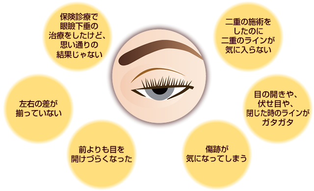 目元 眼瞼下垂の他院修正なら神戸 こうべ花時計クリニック