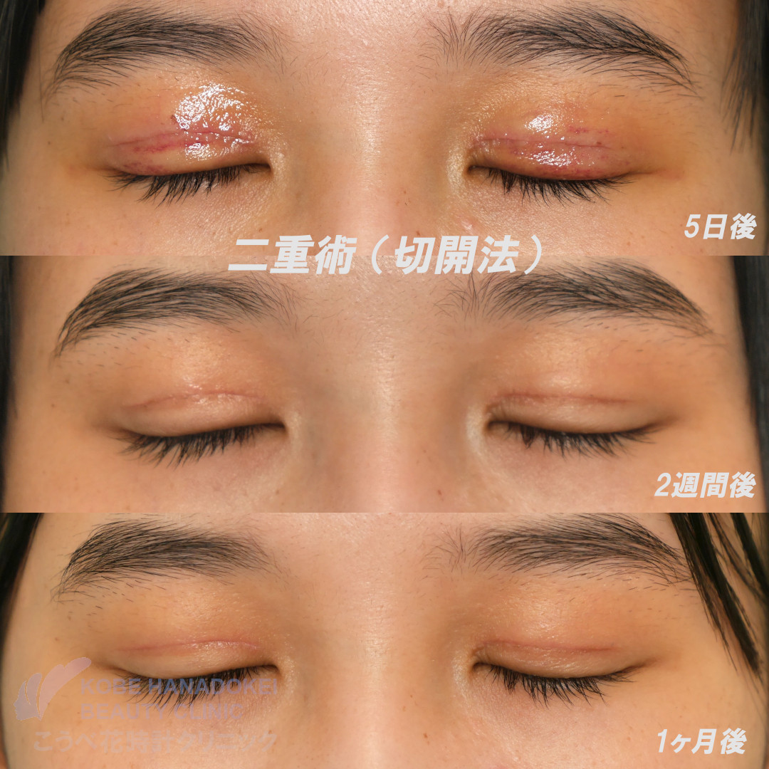 切開法重瞼術~mix型ないし狭めの平行型二重~ | 神戸三宮駅徒歩3分のこうべ花時計クリニック
